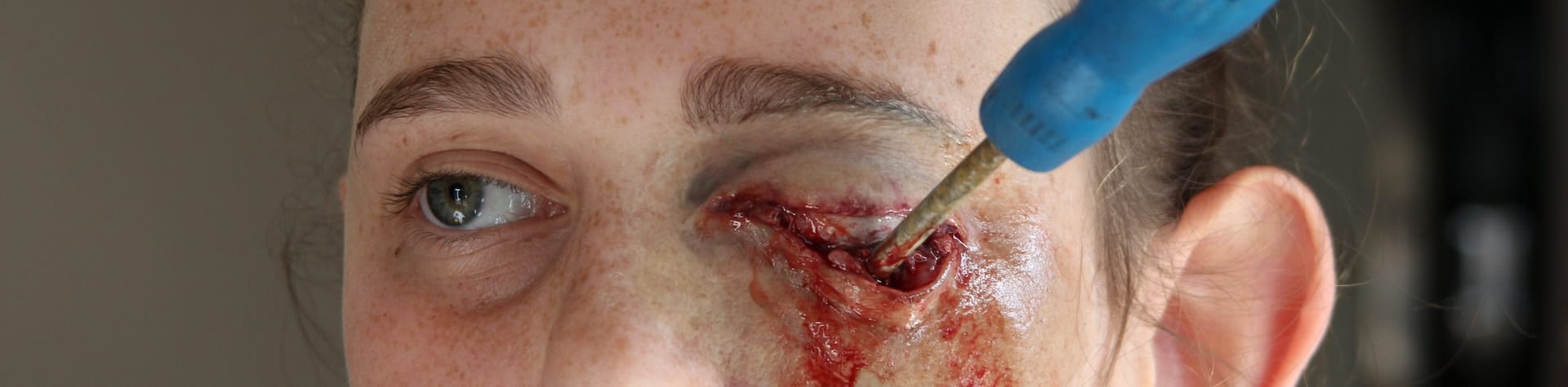 prosthetic eye